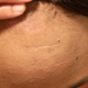 Image for article titled Dr. Pimple Popper Treats Someone With a Tennis Ball-Sized Lump in His Neck